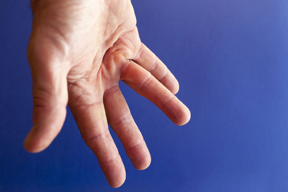 Dupuytren’s Contracture &#8211; Causes, Symptoms, and Home Remedies