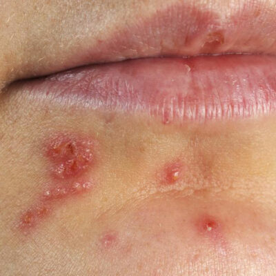 4 effective ways to treat herpes