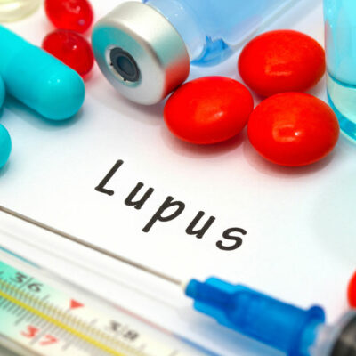 General Procedures Involved in Lupus Management