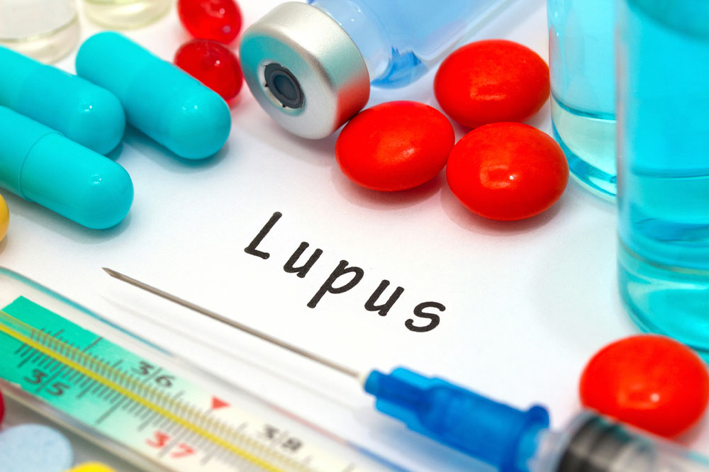 General Procedures Involved in Lupus Management