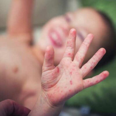 Prevention Tips for Hand, Foot, and Mouth Disease