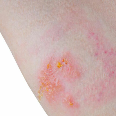 Skin Rash: Which condition is it?