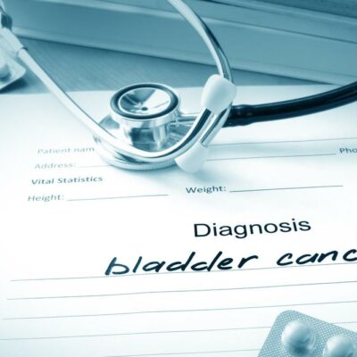 The Common Causes of Bladder Cancer