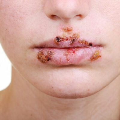 Tips to manage herpes outbreak