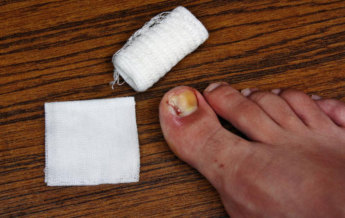 Ways to Treat Toe Nail Fungus During Pregnancy