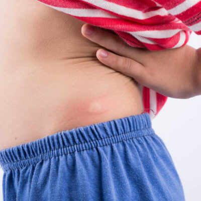 6 Daily Activities That Help In Shingles Rash Treatment