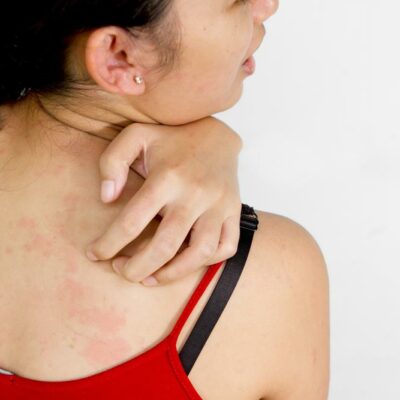 Atopic Dermatitis- Causes, Symptoms And Treatment