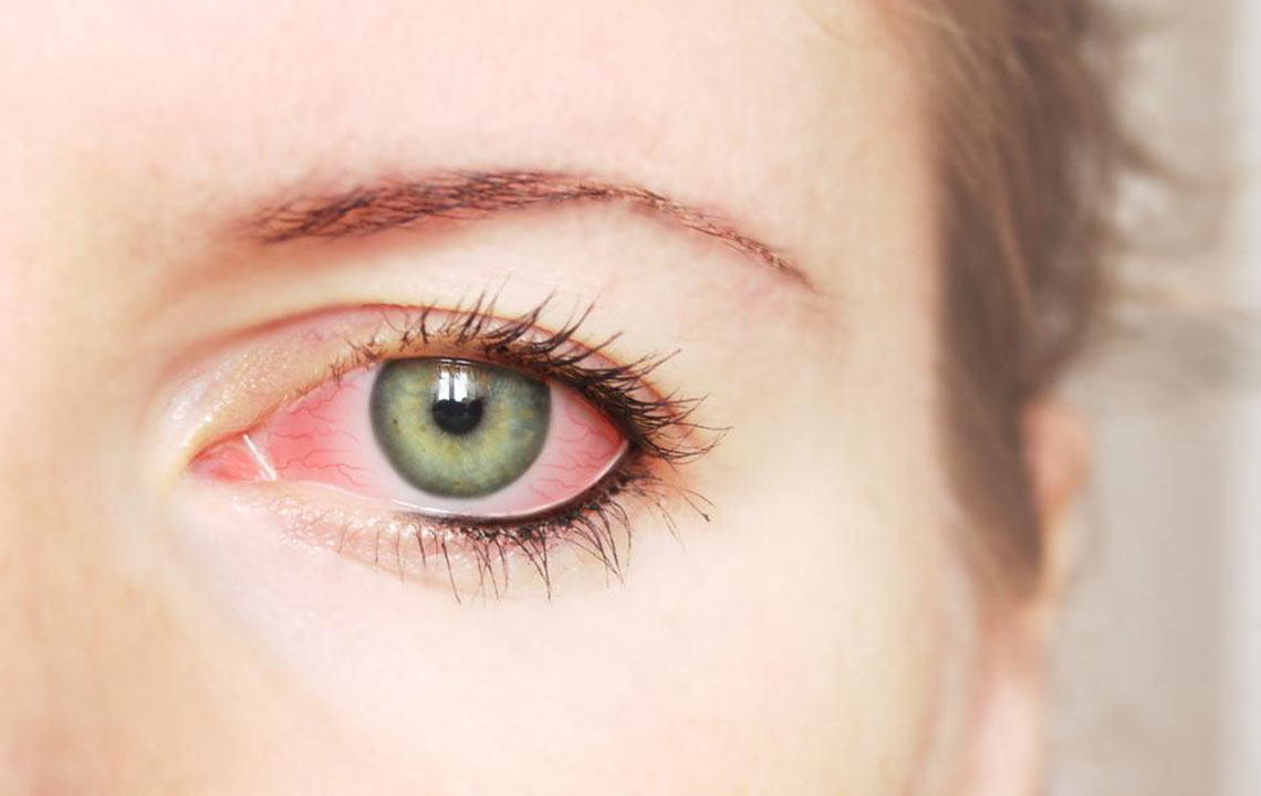 Common Causes and Treatments for Red Eye