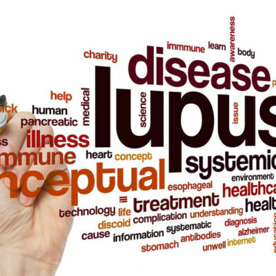 Common Symptoms of Lupus in Women