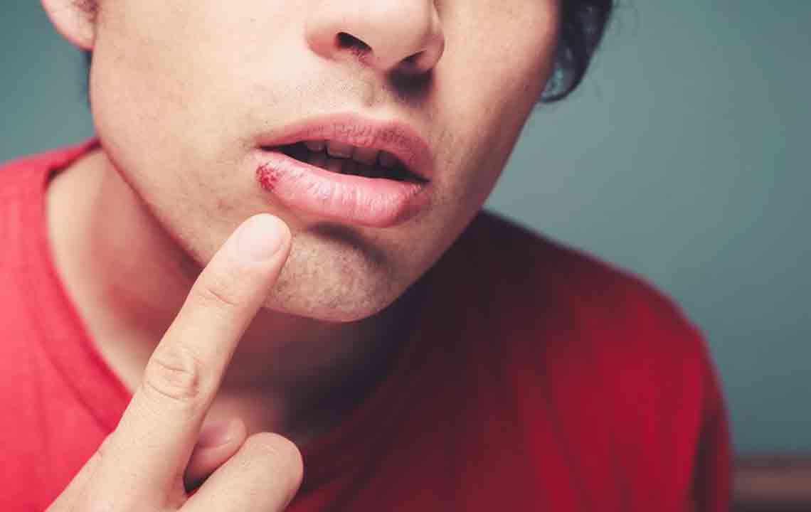 Effective Home Remedies for Treating Cold Sores