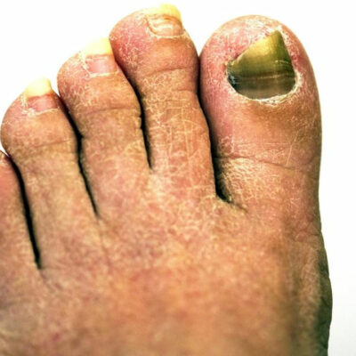 Get Rid of Toenail Fungus With the Right Treatment