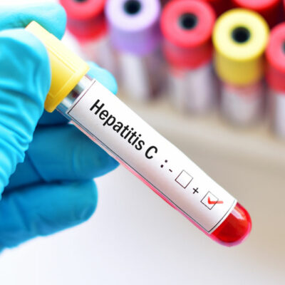 Hepatitis &#8211; types and contributing factors