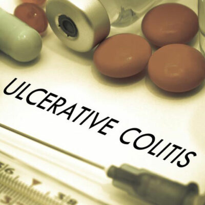 Here Are Some of the Popular Ulcerative Colitis Treatments