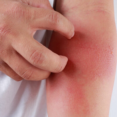 Here&#8217;s How to Identify a Skin Rash