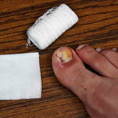 Popular Ways to Treat Toenail Fungus