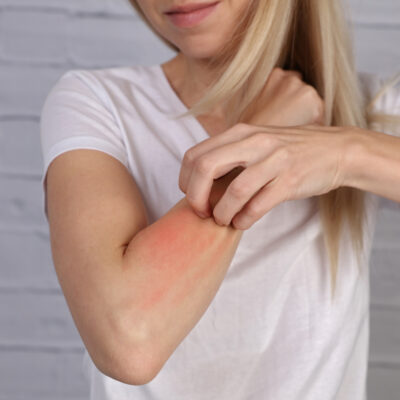 Psoriasis Medications And Their Side Effects