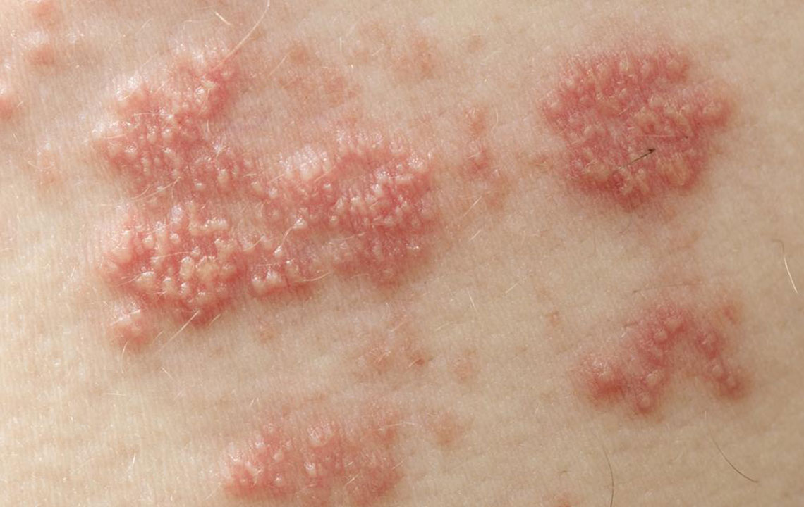 The Treatments for Shingles You Should Know